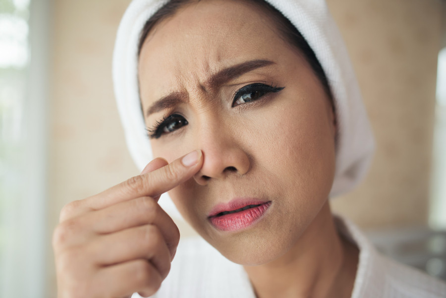 Komedo Di Hidung Sulit Hilang? Ini Alasan dan Cara Atasinya